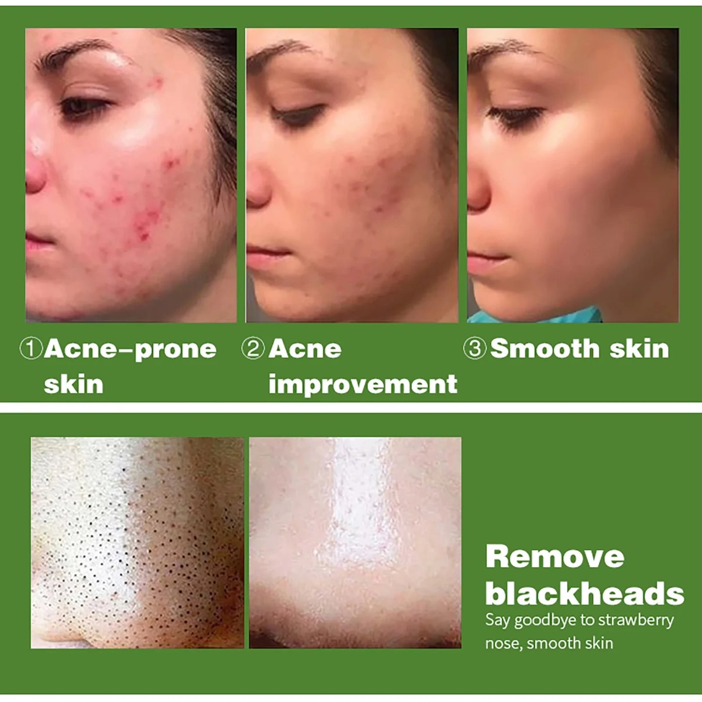 AILKE Organic Anti-Acne Cleansing Face Care Set, Smooth Skin, Remove Stains, Spots, Prevent Breakout, for All Skin Types